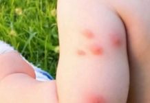 KOMARCI VAM PRAVE PAKAO OD ŽIVOTA? Samo isijecite OVO VOĆE na pola i ostavite u sobi, VIŠE IH NIKADA NEĆETE VIDJETI BLIZU!