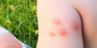 KOMARCI VAM PRAVE PAKAO OD ŽIVOTA? Samo isijecite OVO VOĆE na pola i ostavite u sobi, VIŠE IH NIKADA NEĆETE VIDJETI BLIZU!