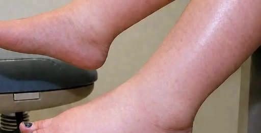 DA IZBACITE VIŠAK VODE POTREBAN VAM JE JEDAN VITAMIN: Ni noge vam više neće oticati, samo ga ubacite u ishranu…
